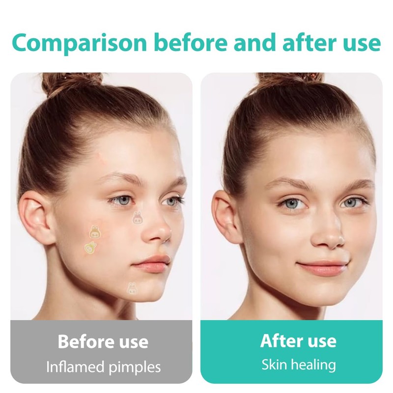 EIROVYA Pimple Patches Pickel Patch Hydrokolloid Akne Pimple Patch mit