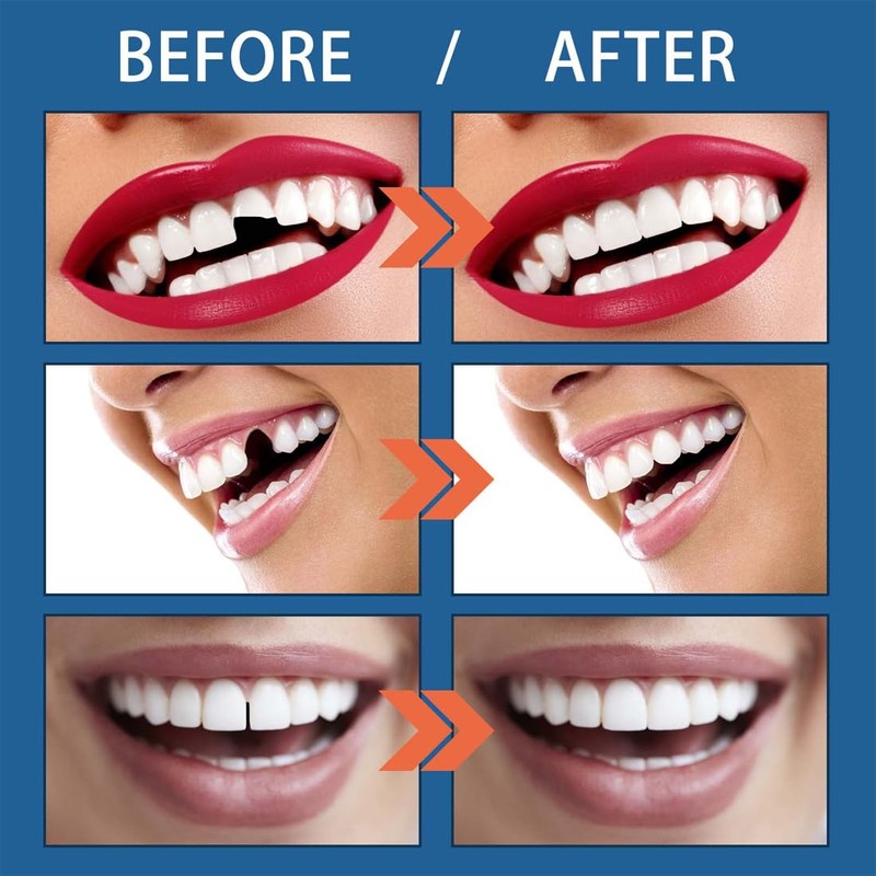 JAWUZ Dental Repair Kit, Make Yourself, Temporary Tooth Repair for