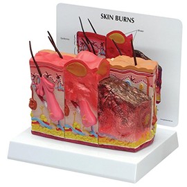 Skin Burn-Normal Skin Model