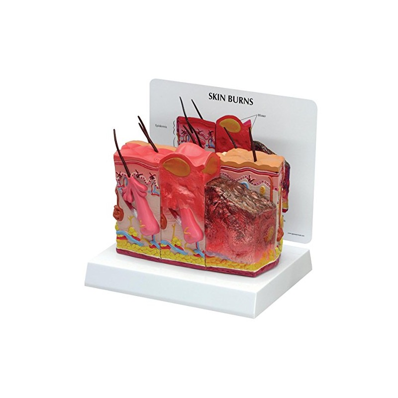 Skin Burn-Normal Skin Model