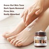 Niacinamide Treatment Cream, Dark Spot Remover Cream for Dark Knuckle,