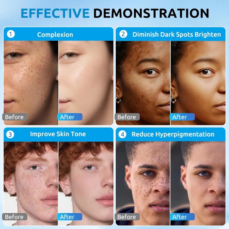 Crema Correctora De Manchas Oscuras Para Hiperpigmentación,