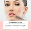 Parches Para Acne Granos Hidrocoagulante Para Espinillas Pim