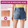Ass Acne Cream, Pimple Cream, Pimple Reduction, Pimple Reduction, Restore