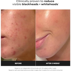 Paula's Choice Skin Perfecting - Líquido salicílico exfoliante 2% BHA, exfoliante facial para puntos negros, poros grandes, arrugas y líneas finas