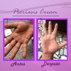 Crema Facial & Corporal Psoriasis Cream Hidratante Aliviante