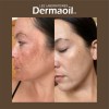 Tratamiento Avanzado Y Completo Para Melasma ( Paño )