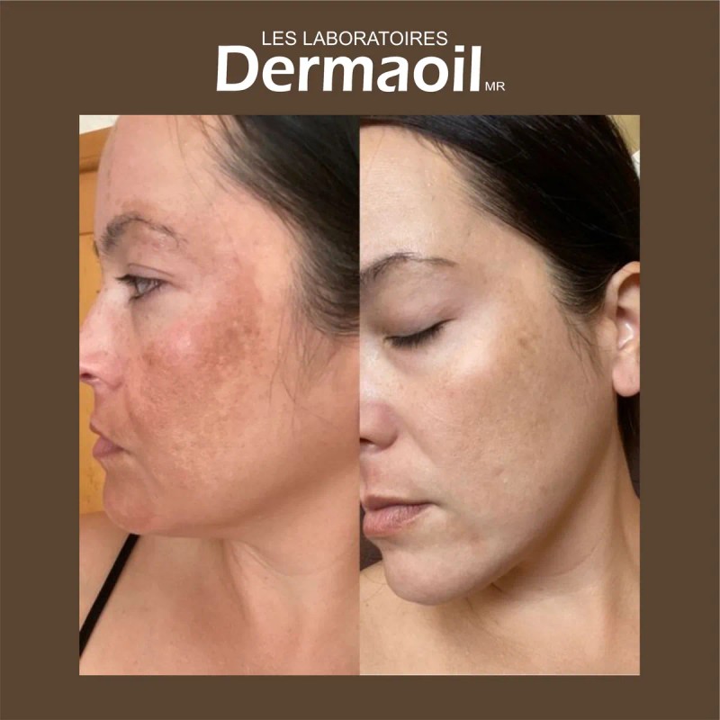 Tratamiento Avanzado Y Completo Para Melasma ( Paño )