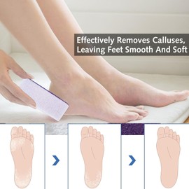6 Stück Bimsstein für Füße, Hornhautentferner, Peeling & Glättung der Haut, Fußabdruckentferner|Hautschwielenbimsstein|Fußbimsstein (lila)