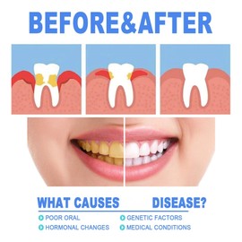 5PCS Gum Repair Gel,Natural Gum Repair Ge/l,Instant Teeth Whitening Pen,Effectively Prevent and Improve Gu/m Problems,Deeply Cleaning G/ums,Gu/m Shield G/el and Whitening,Enhances Overall G/um Health