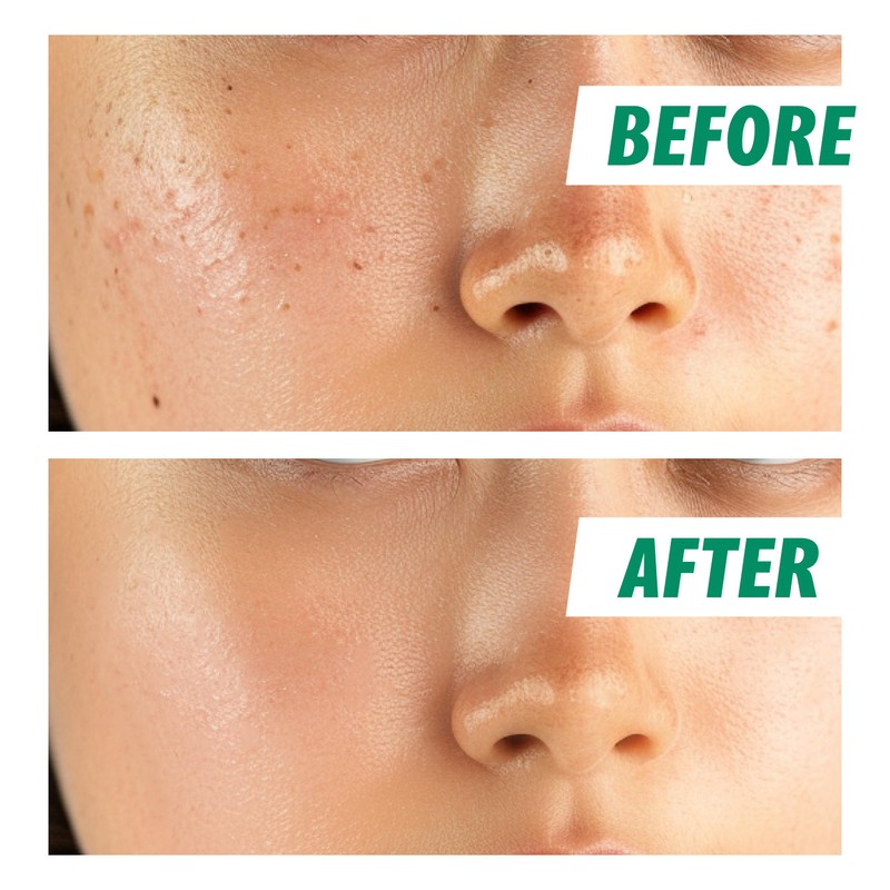 Nightingale Tea Tree Calming Pad, Tea Tree & Facial Toner