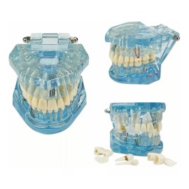 Youya Dental Estudio De Enfermedad Modelo De Dientes Con Implantes Dental