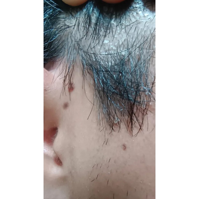 Shampo Sólido Anticaspa - Psoriasis Cinnafix
