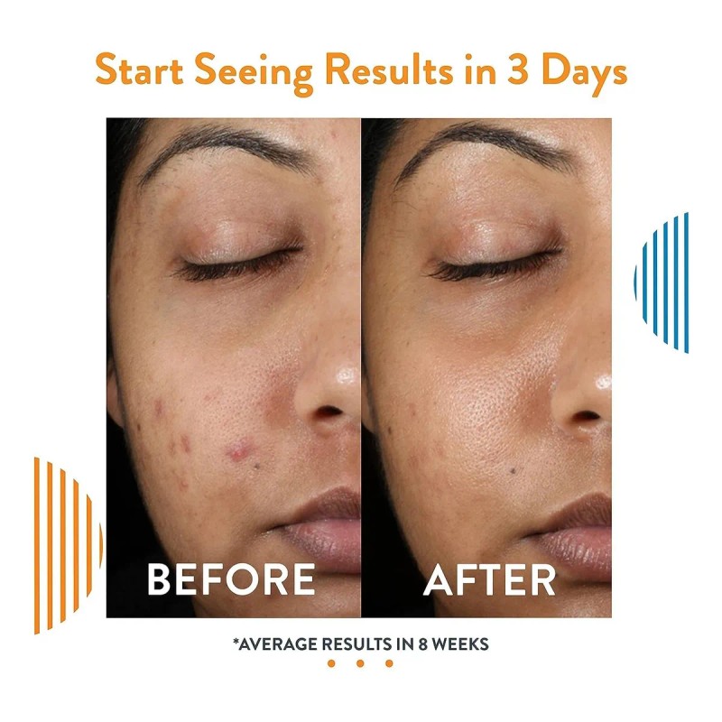 Tratamiento Anti Acné Barros Espinillas 60 Dias Envio Gratis