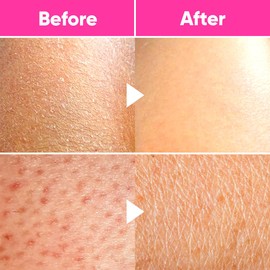 Ame Pure Exfoliating Glove - Exfoliating Mitt for Body - Gentle, Durable Hammam Exfoliating Glove - Chemical Peel Alternative - Premium Exfoliating Mitt for Dead Skin - Transform Your Skin in Seconds!