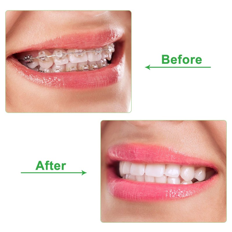 10 Pieces Aligner for Aligner Chompers Aligner Trays Seater Orthodontic