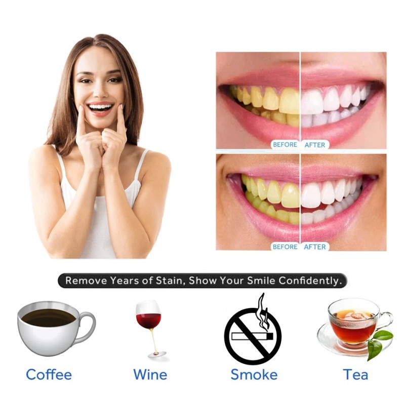 Teeth Whitening Gel 45% Peroxide – 10 Syringe Dental Whitening