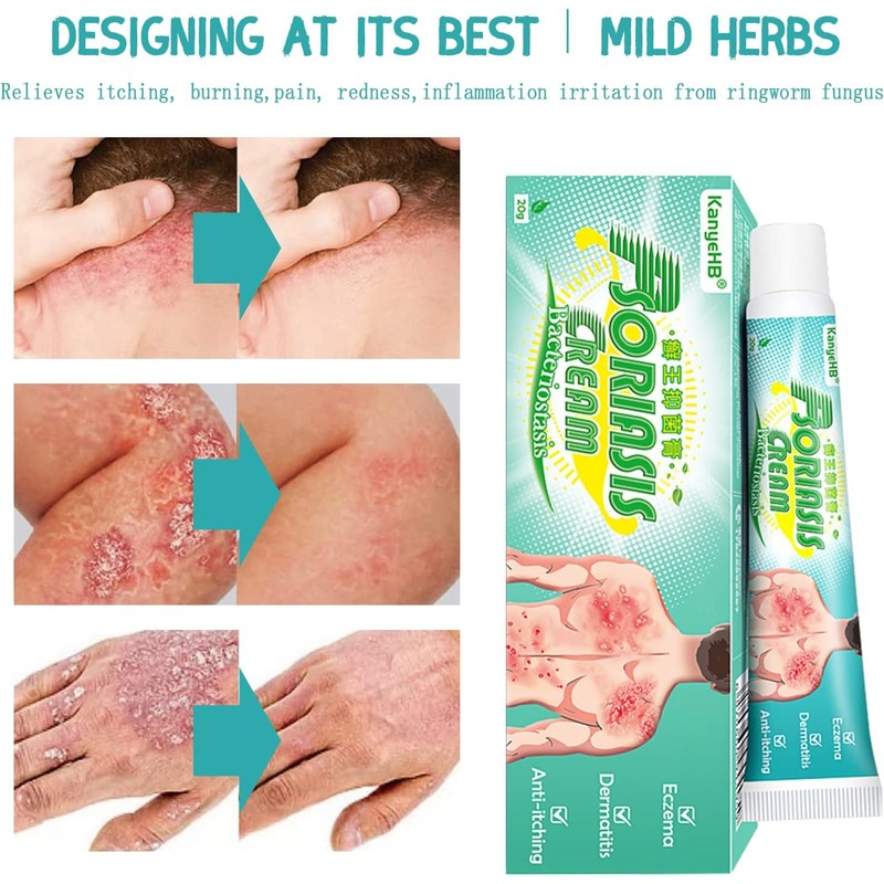 Crema Para Psoriasis Y Eczema, Crema Natural A Base De