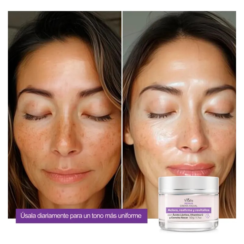 Crema Despigmentante Para Manchas, Melasma, Acné Y Paño 50g