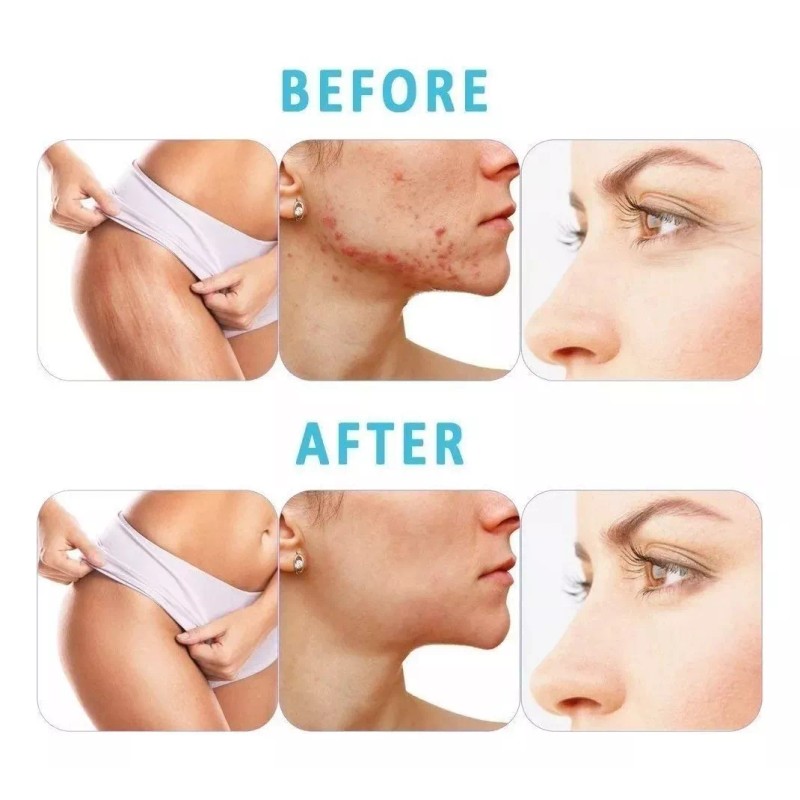 Dermaroller Facial Barba 0.5 Mm Titanio Regenera Colágeno