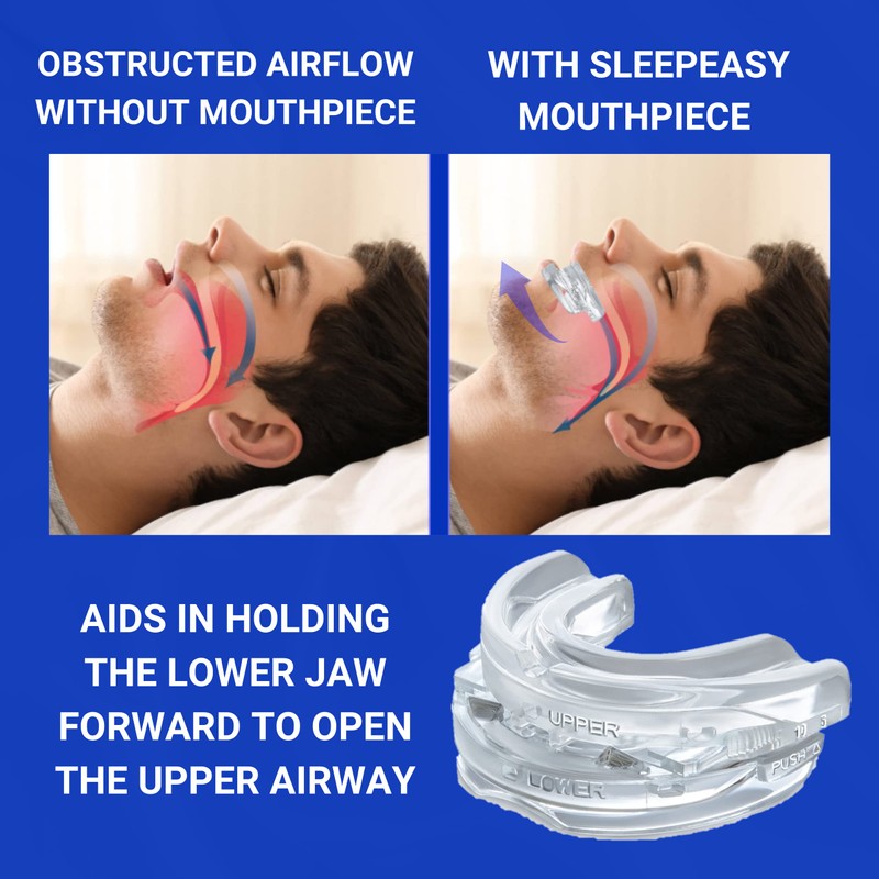 AFFINA sleep easy mouth piece stop snoring device with adjustable