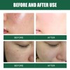 2 Pcs Mite Removal Oil Soap Household Skin Care Acne