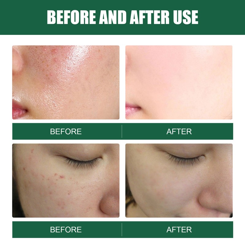 2 Pcs Mite Removal Oil Soap Household Skin Care Acne