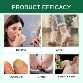 Natural Tea Tree Oil Feet Spray, Foot Care Agent, Foot and Nail Care Tea Tree Spray, Natural Tea Tree Oil Foot Fresh Mist, Aloe Vera Feet Spray, Nail Solution Feet Spray