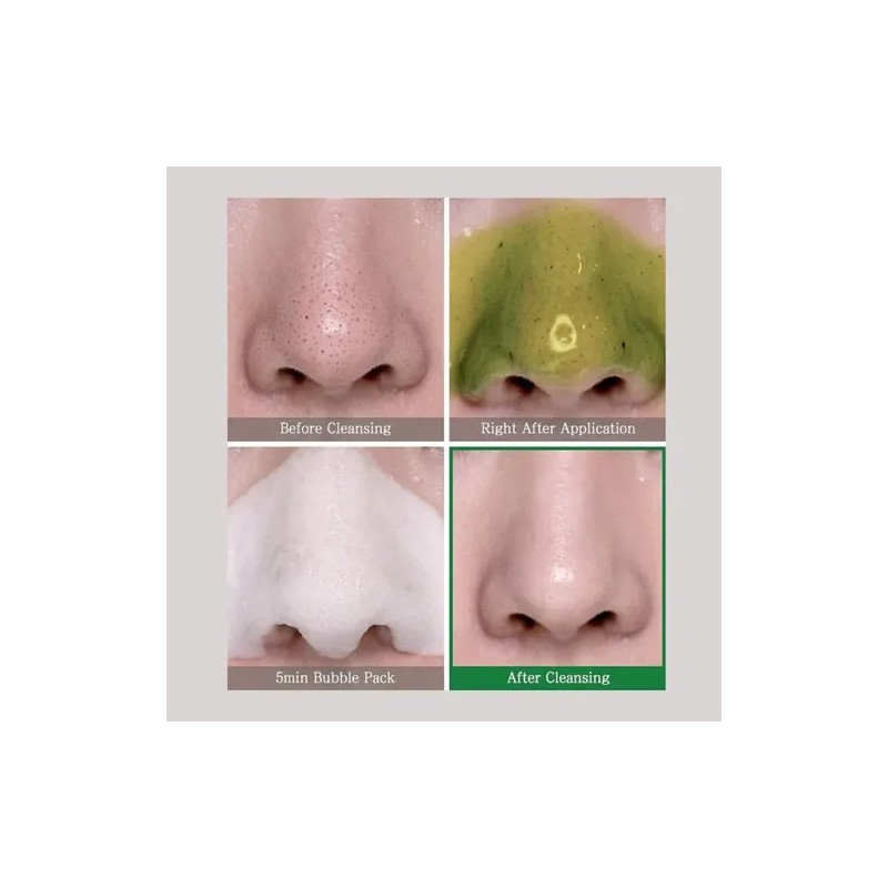 Some By Mi 30 Days Miracle Acné 4 Productos