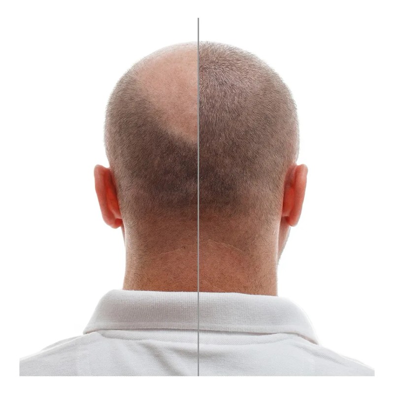 Finasterida 1mg 30 Tabletas Parksteride