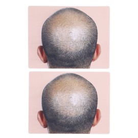 Man Bald Micropigmentattion Practice Skin Silicone Hairline Microblading Practice Pads for Scalp Practice