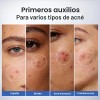 Suero De Ácido Salicílico Al 1,8%, Tratamiento Para El Acné