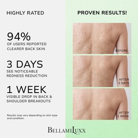 BellamiLuxx Back and Body Acne Treatment Spray: 2% Salicylic Acid & Tea Tree Oil Bacne Spray for Clear, Soothe & Moisturize - Effective for Men, Women, Teens with Back, Shoulder, Arm, and Chest Acne
