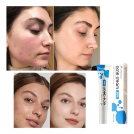 Crema Facial Antiacné Con Ácido Azelaico 20g Todo Tipo De Piel Día/noche