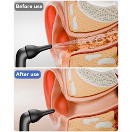 Electric Ear Wax Removal, Ear Cleaning Kit, Water Powered Ear Cleaner with 3 Pressure Modes 12 Replacement Tips, Ear Irrigation Flushing System, Safe and Effective Ear Wax Removal Tool (Black)