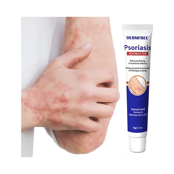 Crema De Tratamiento Psoriasis Para Picazón Y Escamosa
