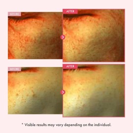 Suero Tosowoong Niacinamida 10% Arbutina 7%, Hiperpigmentaci