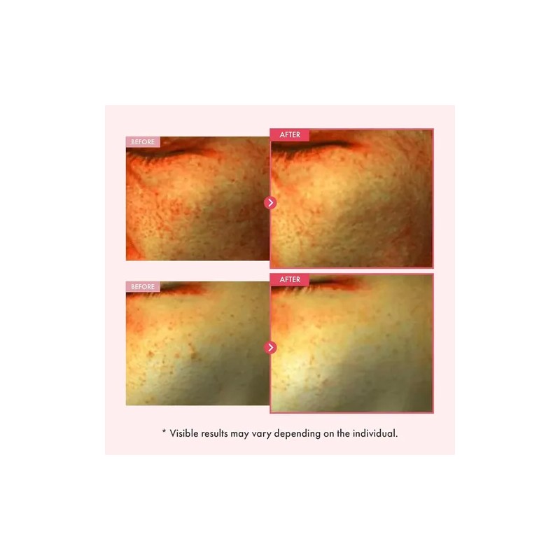 Suero Tosowoong Niacinamida 10% Arbutina 7%, Hiperpigmentaci
