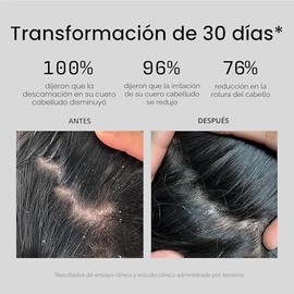 Jupiter Champú Anticaspa - Champú para hombres y mujeres para cuero cabelludo escamoso, con picazón, graso y seco - Nutre el cuero cabelludo y reduce 