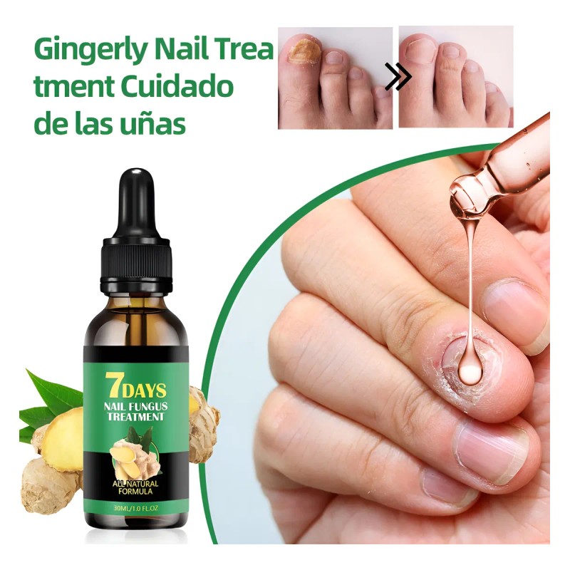 Líquido Para Hongos En Las Uñas-tratamiento Para Uñas