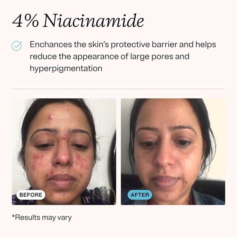 MDacne – Retinol 0.5% and Niacinamide 4% Cream, Reduces Blemishes