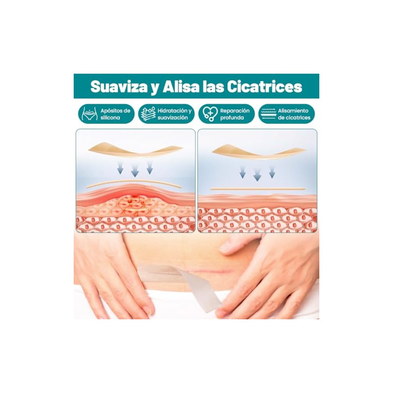 Yakiter 2M4CM Parches de Silicona para Cicatrices,Cinta para Cicatrices Recortable,Impermeable
