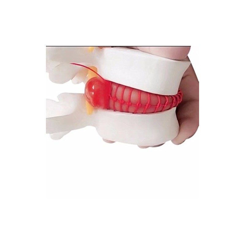 BoNew 1:1.5 Anatomical Human Lumbar Vertebrae Degenerative Lumbar Human Spine