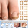 20 Piezas Kit Para Uñas Enterradas, Professional Ingrown Toenail Set,