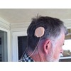 Ear Gear Rondo M1 Mono – Protect Implants from Dirt,