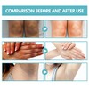 Acanthosis Nigricans Crema, Crema Correctora de Manchas Oscuras,- Axilas, Cuello,