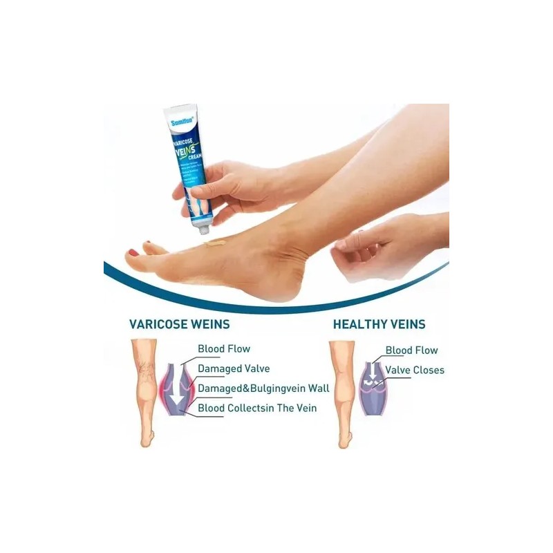 Crema Tratamiento Profesional Varices Venas Piernas Alivia