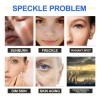 Crema Aclaradora Facial Moteada 50 G, Melasma Speckle Moistu