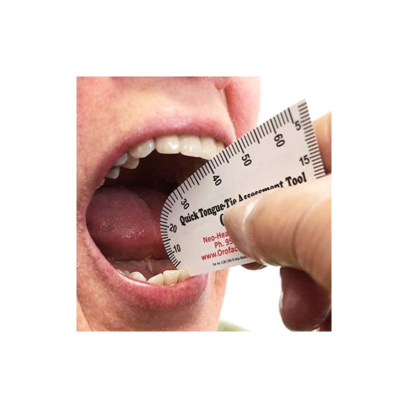 Quick Tongue-Tie Assessment