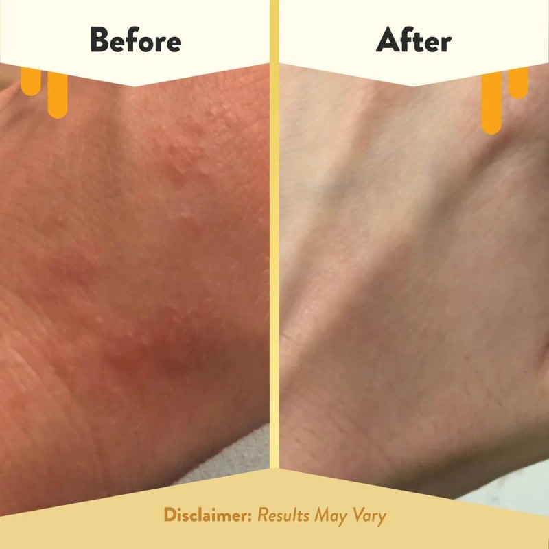 Eczema Honey Loción Corporal De Avena Con Miel Para Eczema